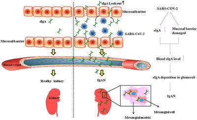 As Signals From the Kawasaki-Like Illness During the COVID-19 Pandemic: Is It Possible That the Incidence of IgA Nephropathy May Increase in the Future